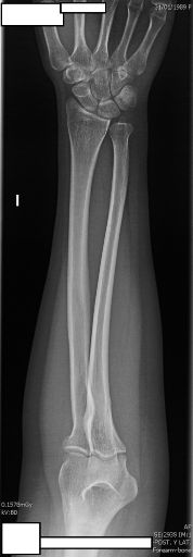 Diagrama PA Antebrazo